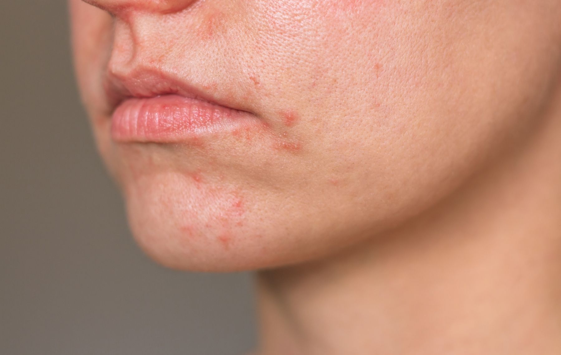 Perioral dermatitis omkring mund på kvinde
